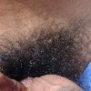genital male hair